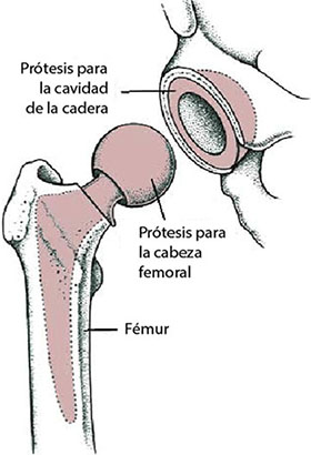 sustitución de la cadera