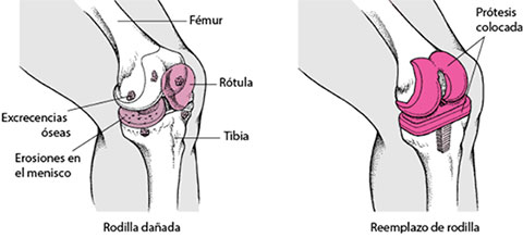 sustitución de la rodilla