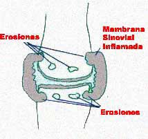 articulación afectada