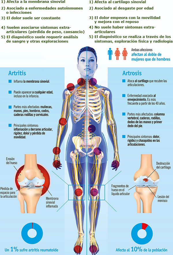 diferencia entre artritis y artrosis