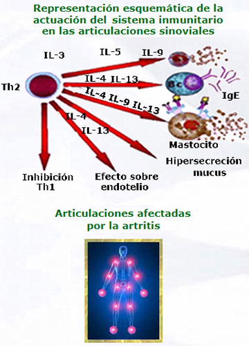 representación esquemática de la actuación del sistema inmunitario en las articulaciones sinoviales